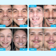 SMILEFIT PRO – PODESIVI SET PROTEZA ZA SAVRŠEN OSMIJEH
